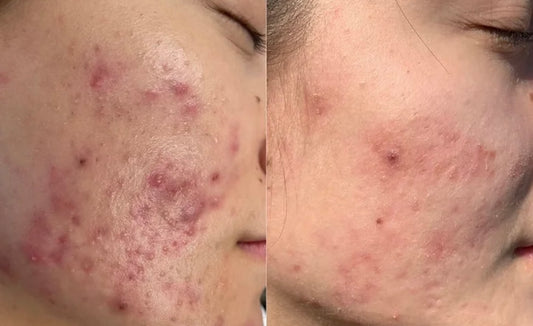 Purity Balance Facial (For acne & Congested Skin) ($120)